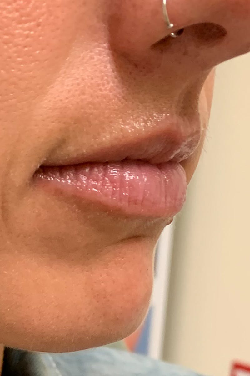 Lip Fillers Before & After Gallery - Patient 51538700 - Image 3