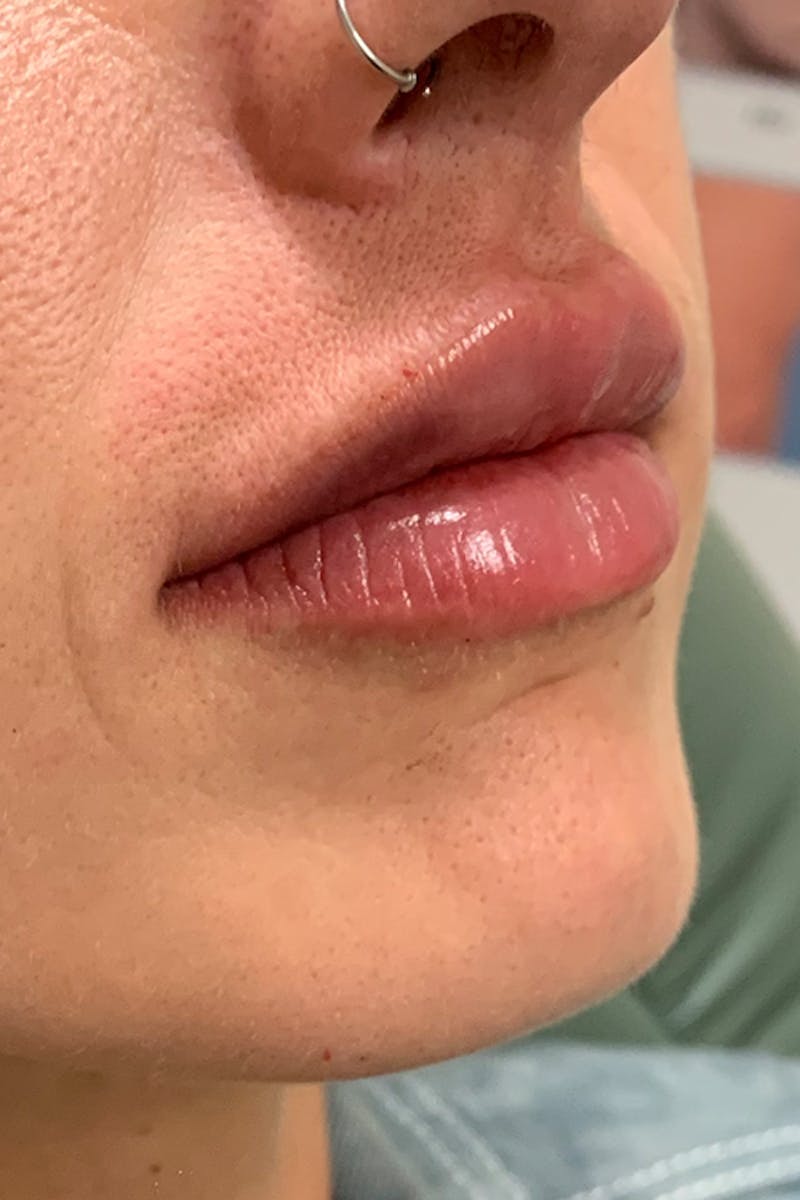 Lip Fillers Before & After Gallery - Patient 51538700 - Image 4