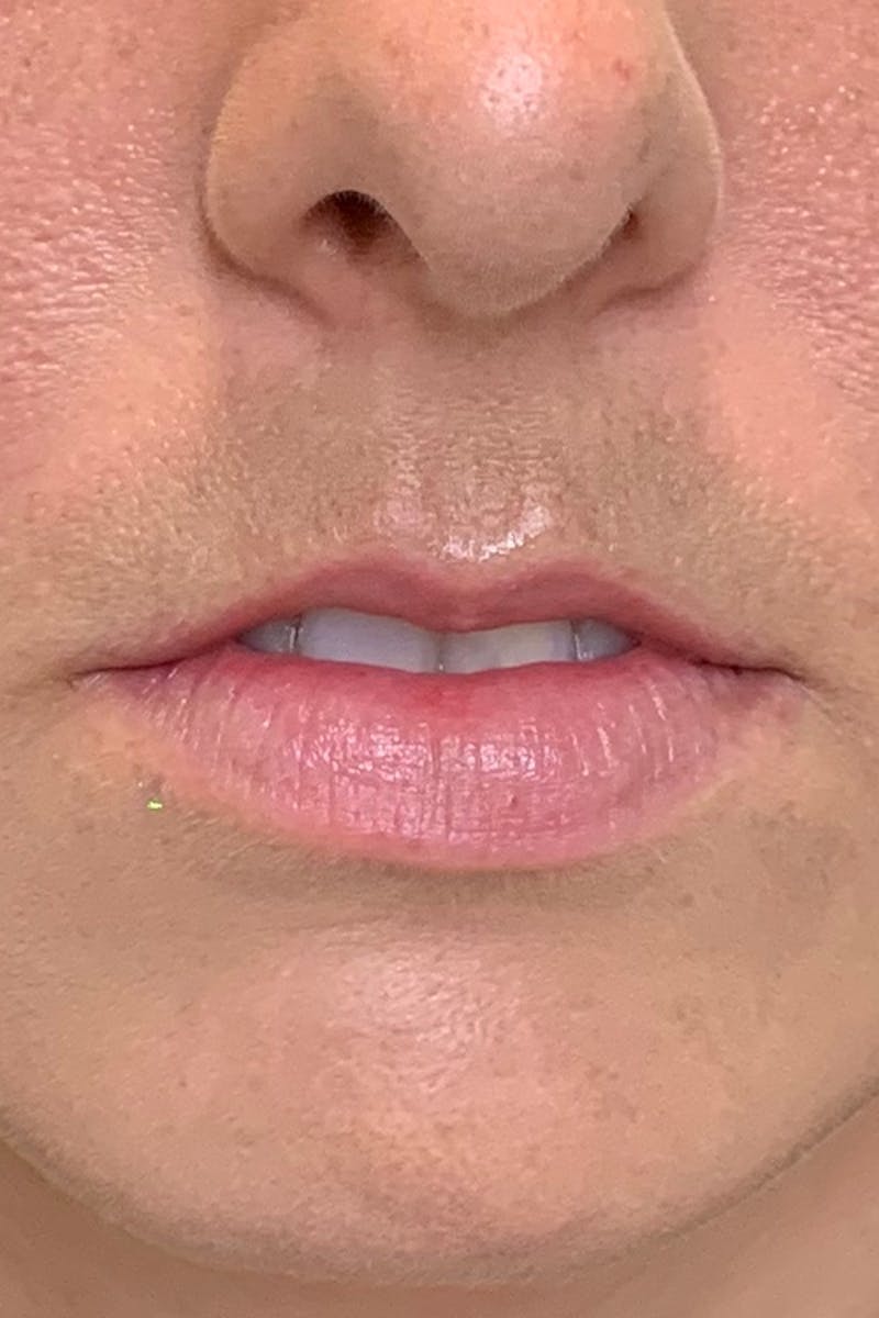Lip Fillers Before & After Gallery - Patient 51538705 - Image 1