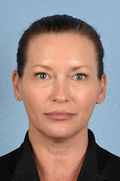 Facial Fillers Before & After Gallery - Patient 51538710 - Image 2