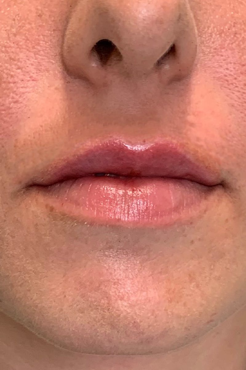 Lip Fillers Before & After Gallery - Patient 51538705 - Image 2
