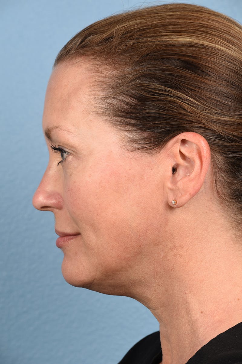 Facial Fillers Before & After Gallery - Patient 51538710 - Image 3