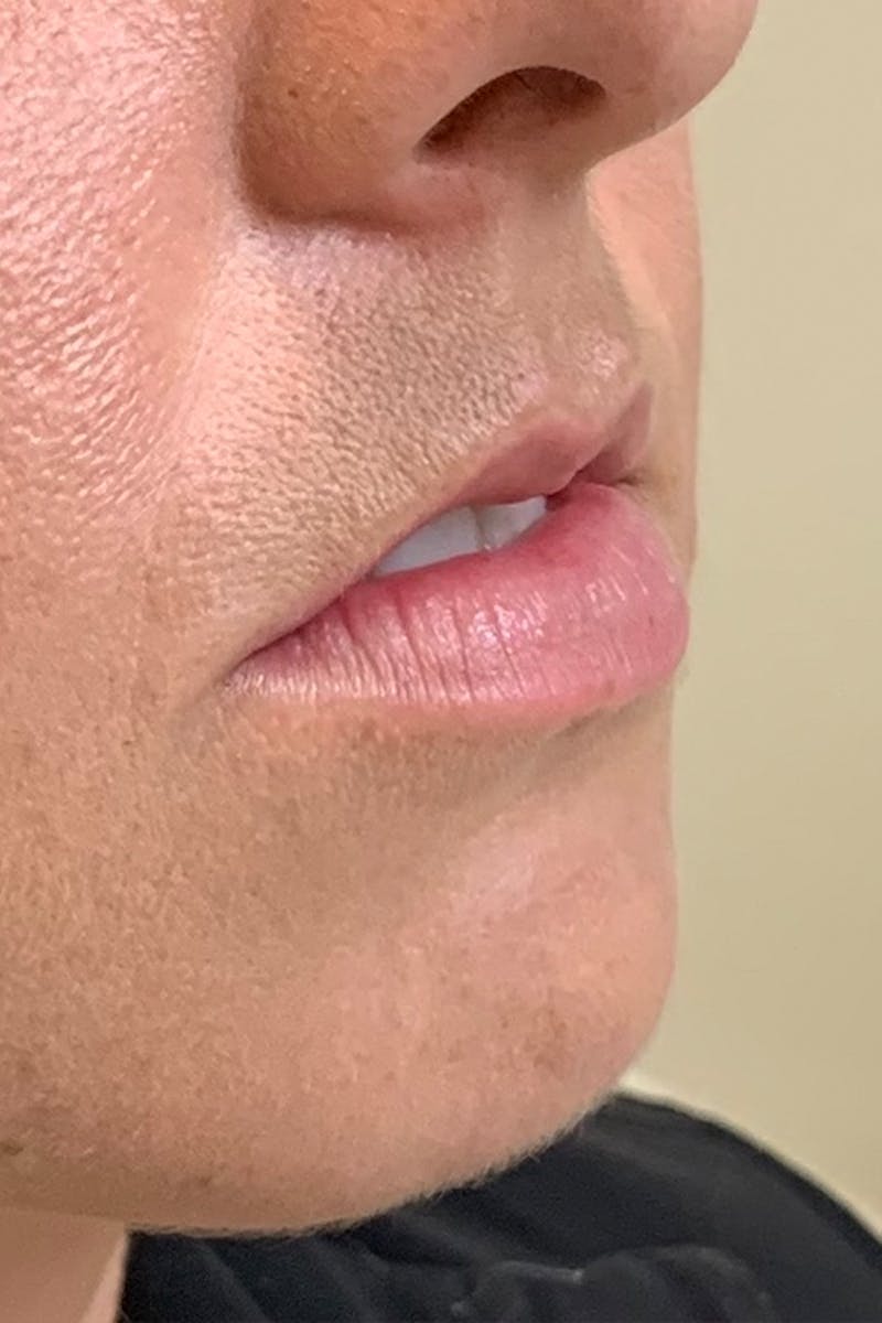 Lip Fillers Before & After Gallery - Patient 51538705 - Image 3