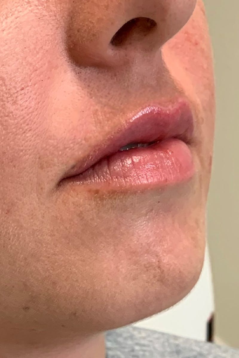 Lip Fillers Before & After Gallery - Patient 51538705 - Image 4