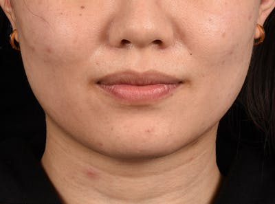 Thermage Flx Before & After Gallery - Patient 51538712 - Image 1