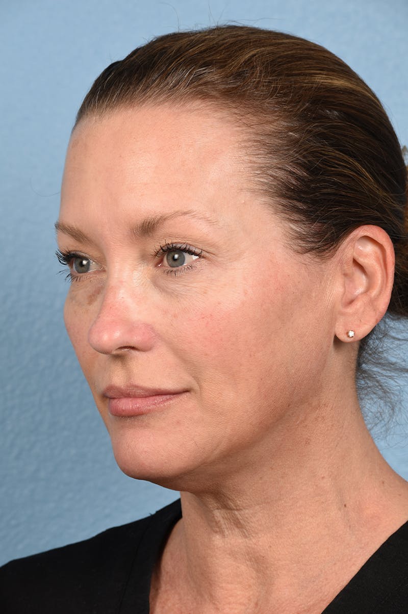 Facial Fillers Before & After Gallery - Patient 51538710 - Image 5