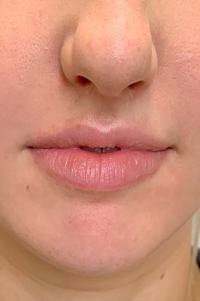 Lip Fillers Before & After Gallery - Patient 51538707 - Image 1