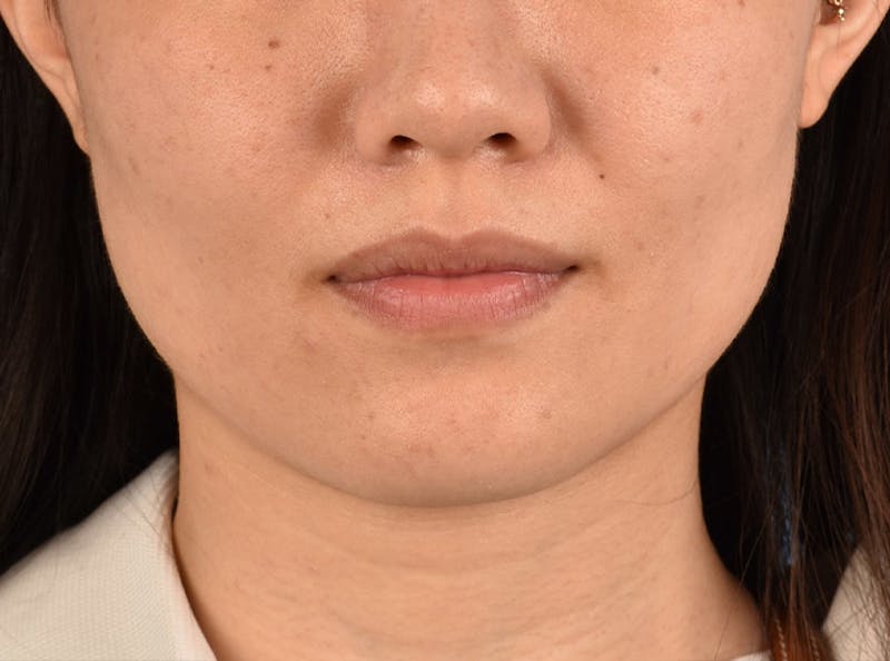 Thermage Flx Before & After Gallery - Patient 51538712 - Image 2