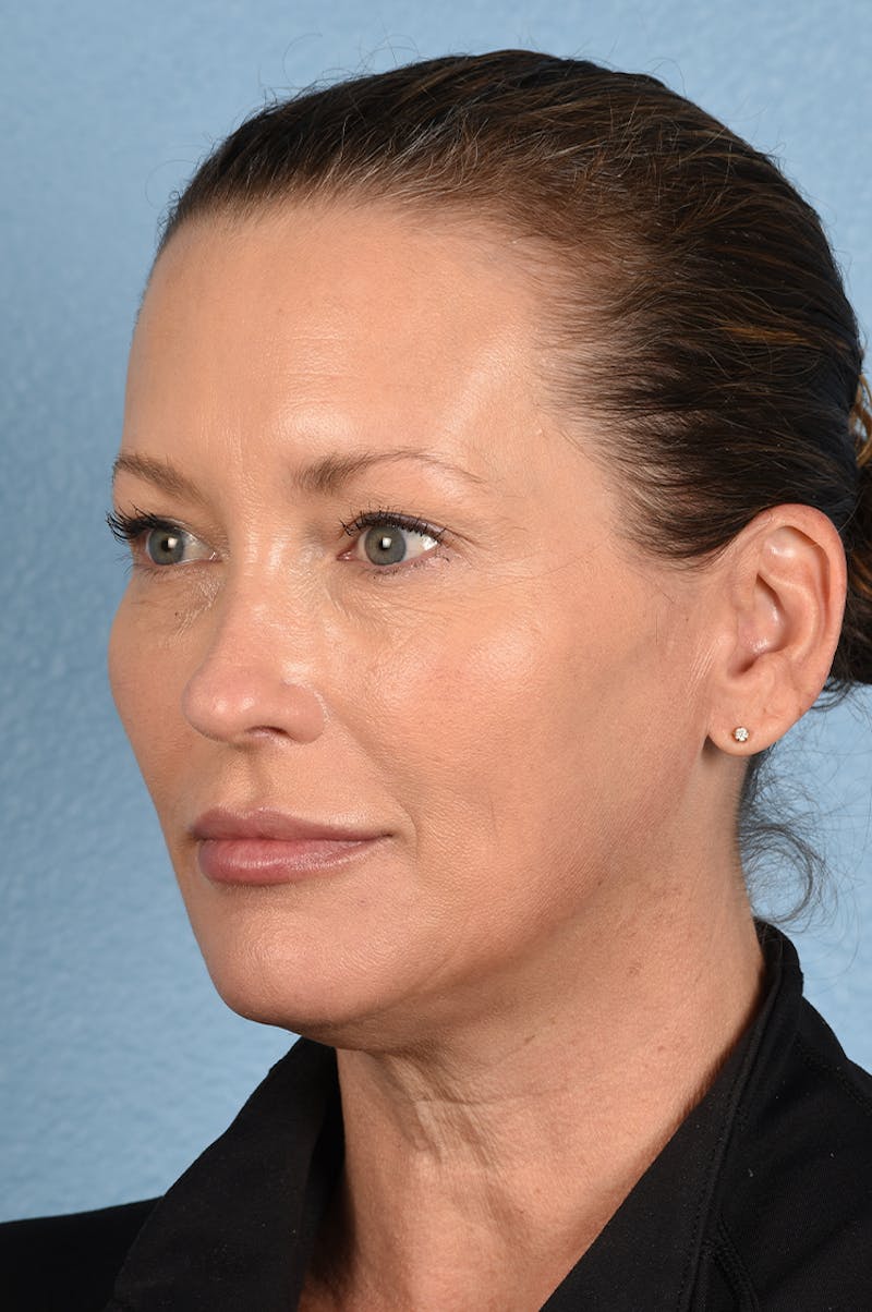 Facial Fillers Before & After Gallery - Patient 51538710 - Image 6