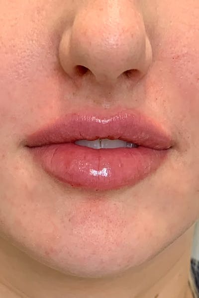 Lip Fillers Before & After Gallery - Patient 51538707 - Image 2