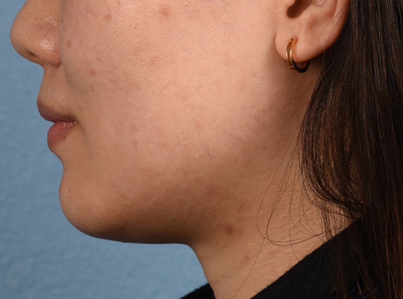 Thermage Flx Before & After Gallery - Patient 51538712 - Image 3