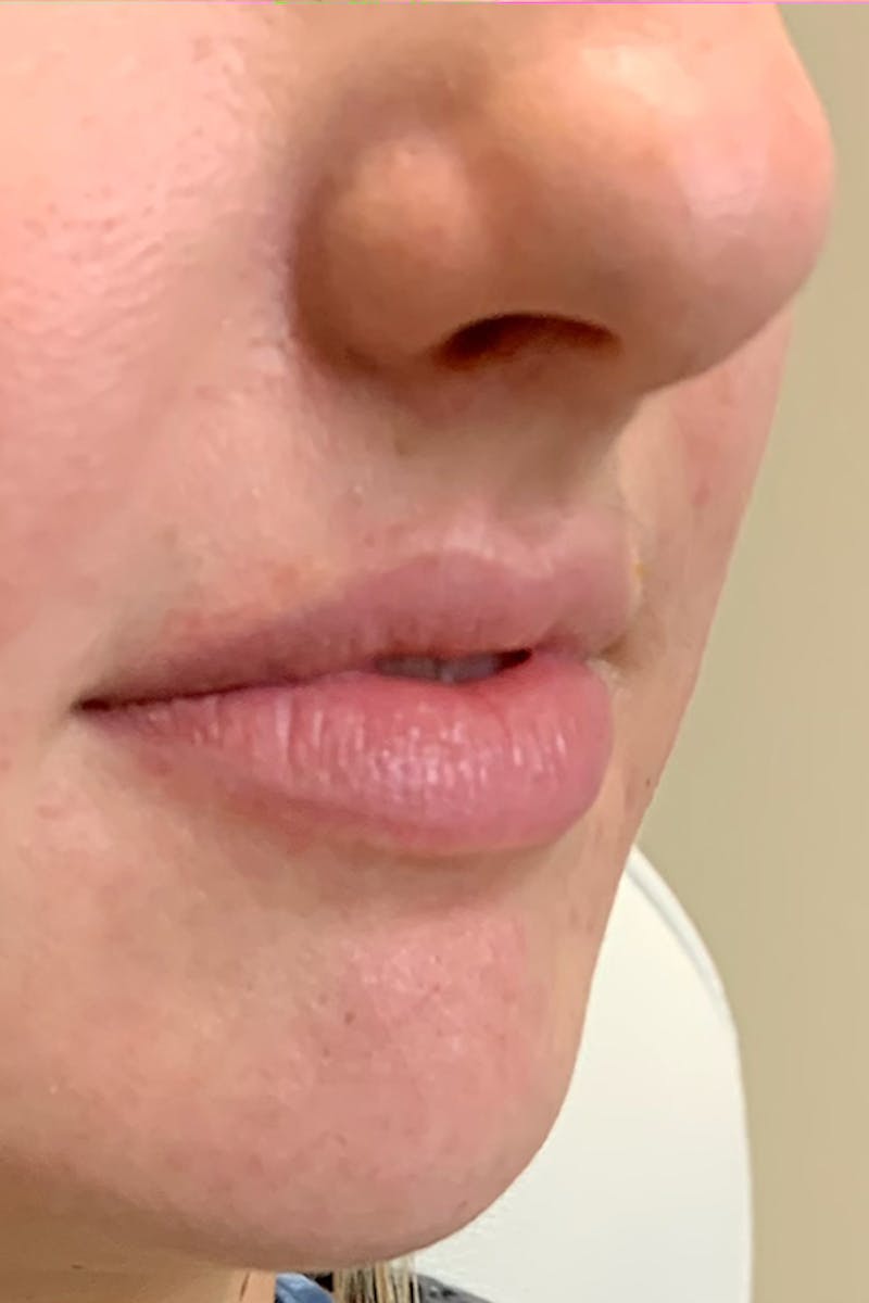 Lip Fillers Before & After Gallery - Patient 51538707 - Image 3