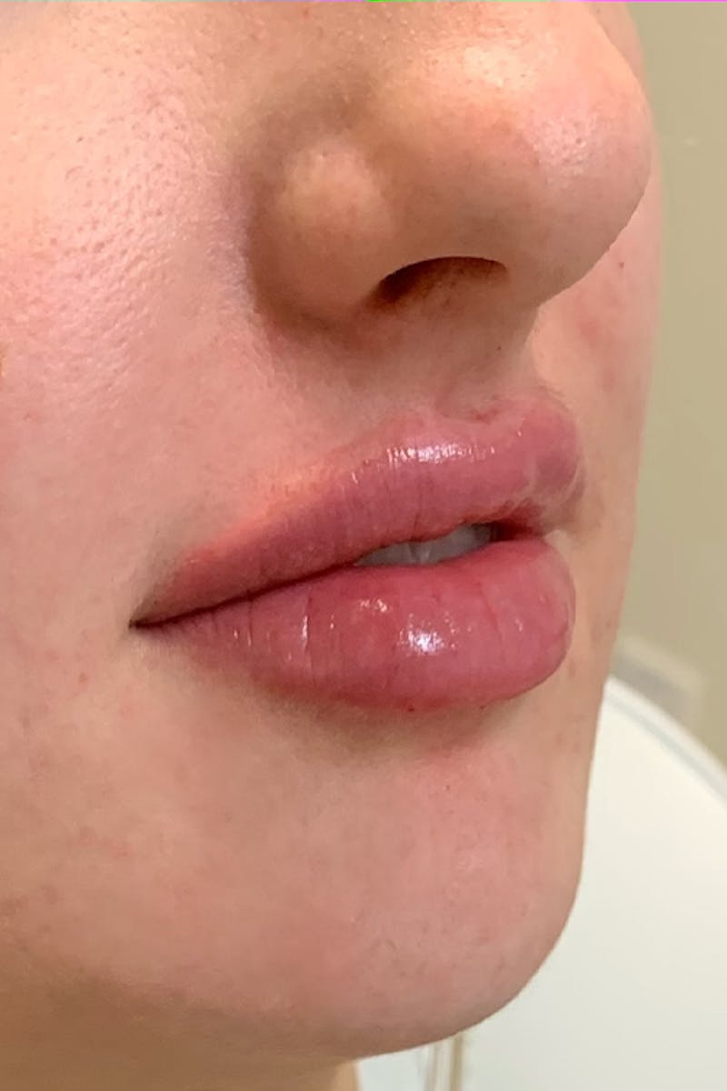 Lip Fillers Before & After Gallery - Patient 51538707 - Image 4