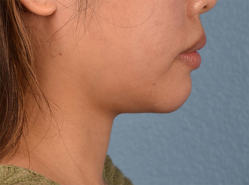 Injectables Before & After Gallery - Patient 51538708 - Image 1