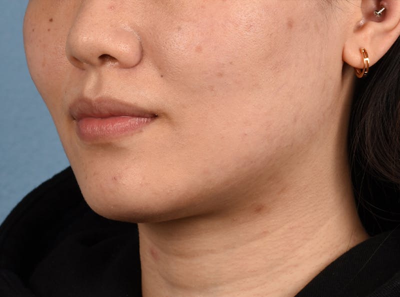 Thermage Flx Before & After Gallery - Patient 51538712 - Image 5