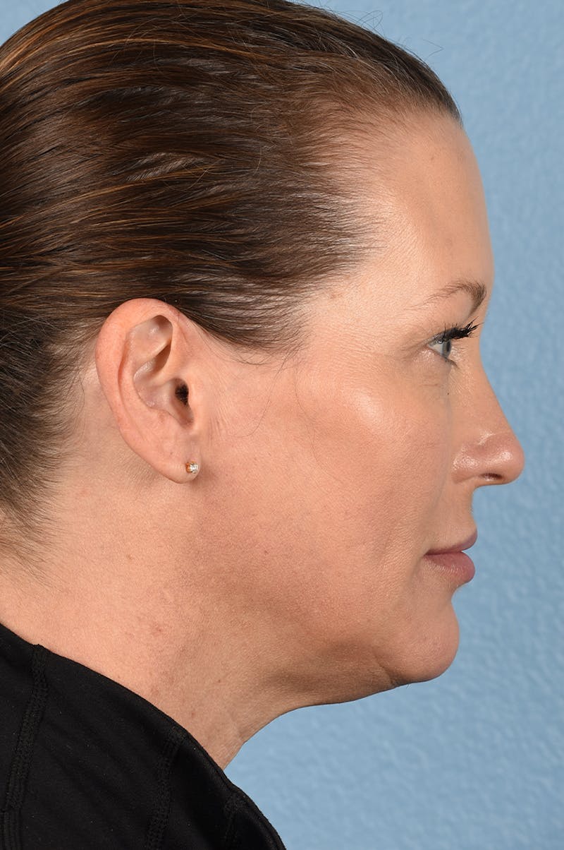 Facial Fillers Before & After Gallery - Patient 51538710 - Image 8