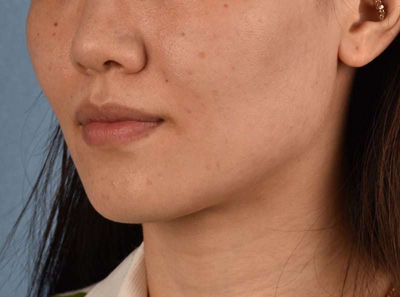 Thermage Flx Before & After Gallery - Patient 51538712 - Image 6