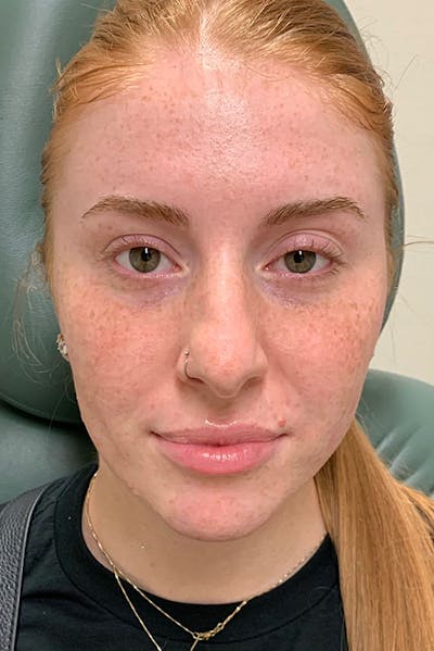 Lip Fillers Before & After Gallery - Patient 51538711 - Image 1