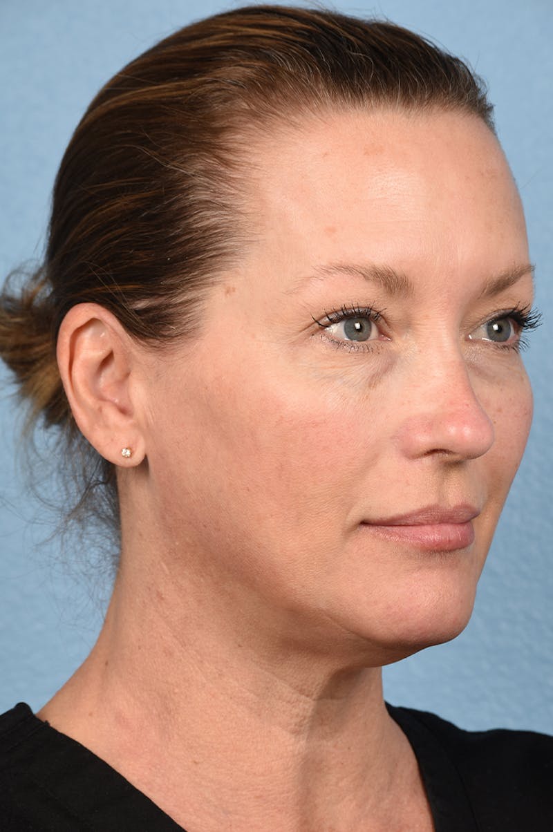 Facial Fillers Before & After Gallery - Patient 51538710 - Image 9