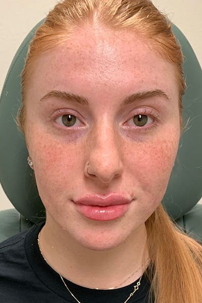 Lip Fillers Before & After Gallery - Patient 51538711 - Image 2