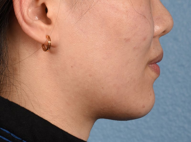 Thermage Flx Before & After Gallery - Patient 51538712 - Image 7