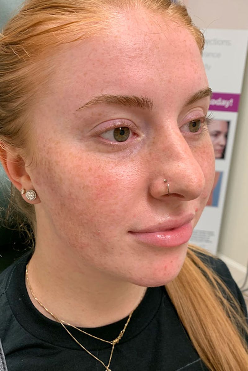 Lip Fillers Before & After Gallery - Patient 51538711 - Image 3