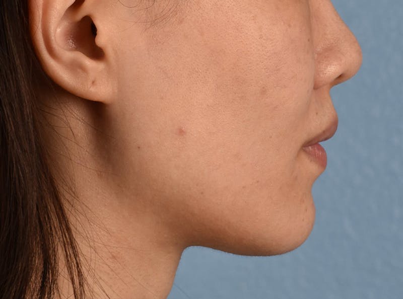 Thermage Flx Before & After Gallery - Patient 51538712 - Image 8