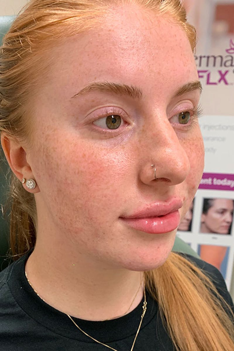 Lip Fillers Before & After Gallery - Patient 51538711 - Image 4