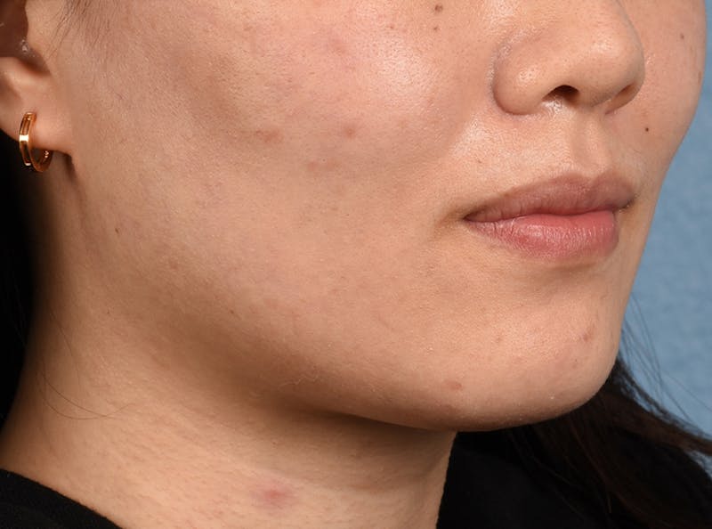 Thermage Flx Before & After Gallery - Patient 51538712 - Image 9