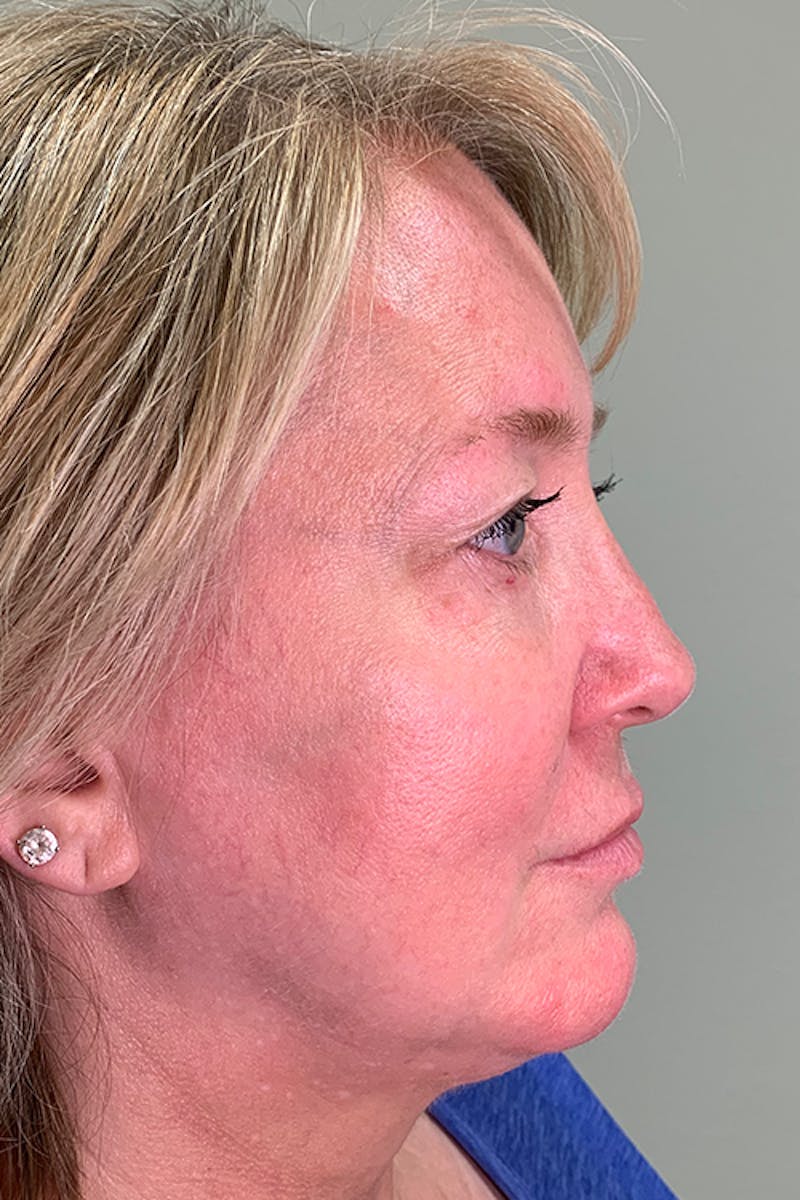 Injectables Before & After Gallery - Patient 51538714 - Image 3