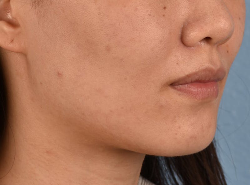 Thermage Flx Before & After Gallery - Patient 51538712 - Image 10