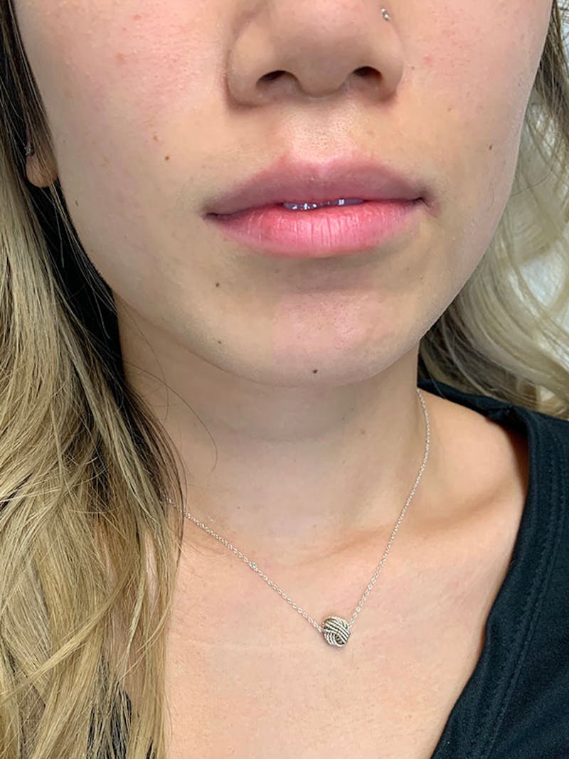 Lip Fillers Before & After Gallery - Patient 51538717 - Image 1