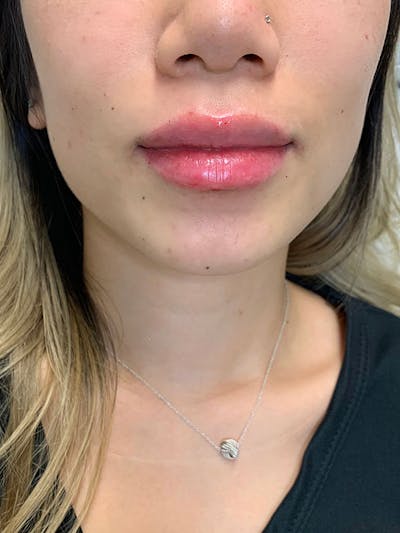 Lip Fillers Before & After Gallery - Patient 51538717 - Image 2