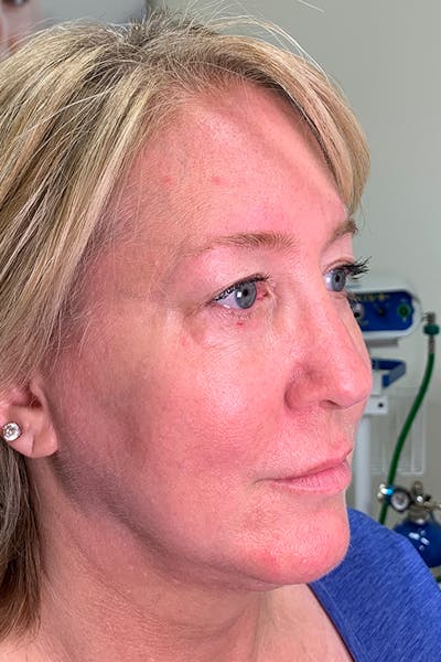 Facial Fillers Before & After Gallery - Patient 51538720 - Image 1