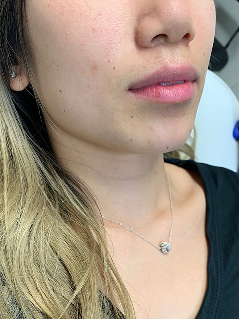 Lip Fillers Before & After Gallery - Patient 51538717 - Image 3