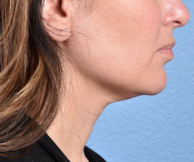 Thermage Flx Before & After Gallery - Patient 51538715 - Image 2