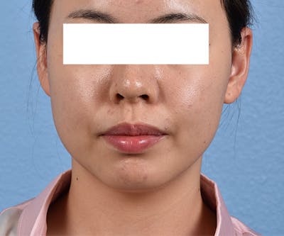 Thermage Flx Before & After Gallery - Patient 51538718 - Image 1