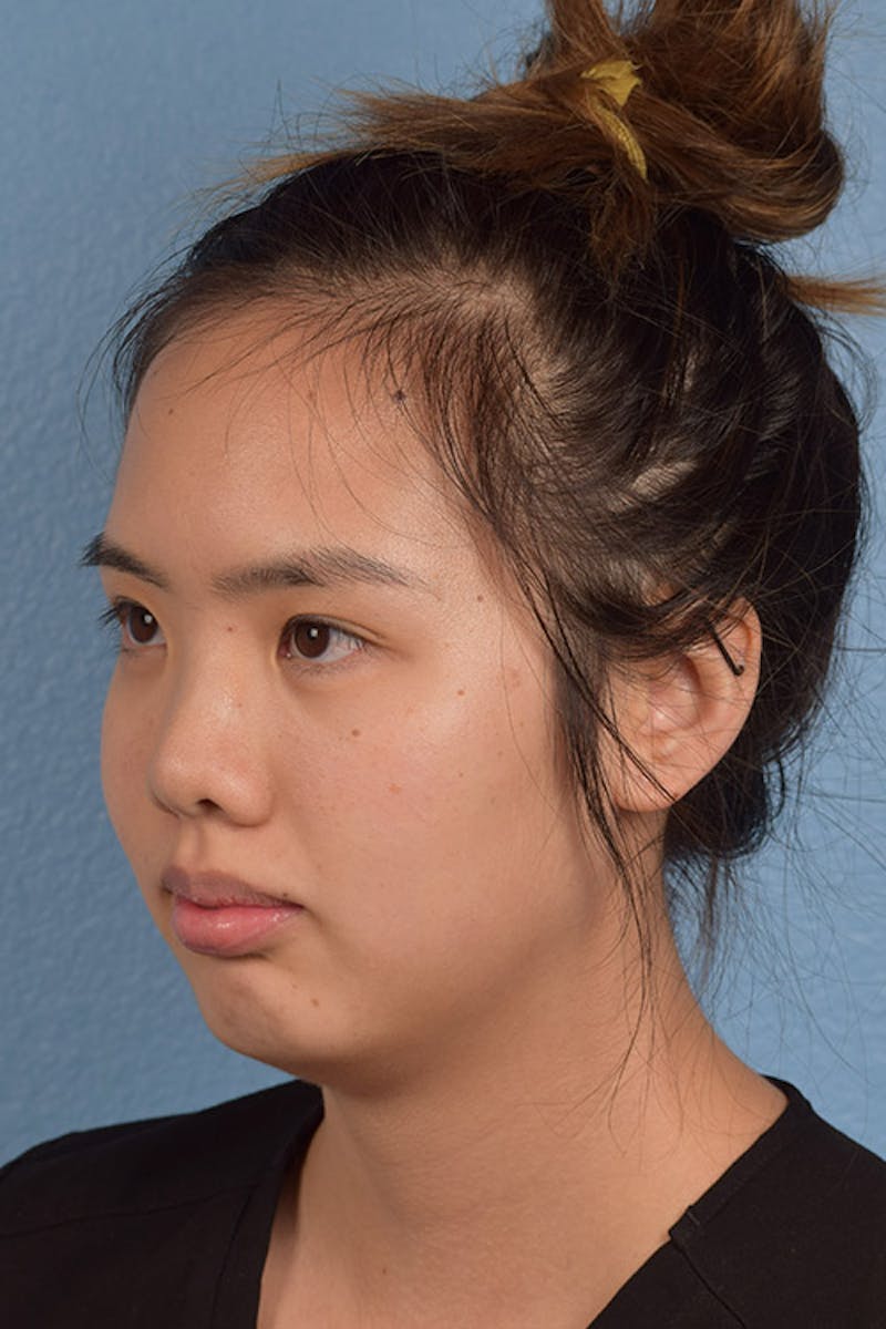Injectables Before & After Gallery - Patient 51538721 - Image 1