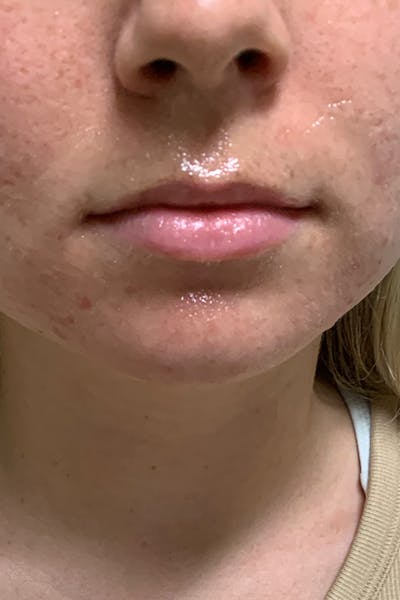 Lip Fillers Before & After Gallery - Patient 51538722 - Image 1