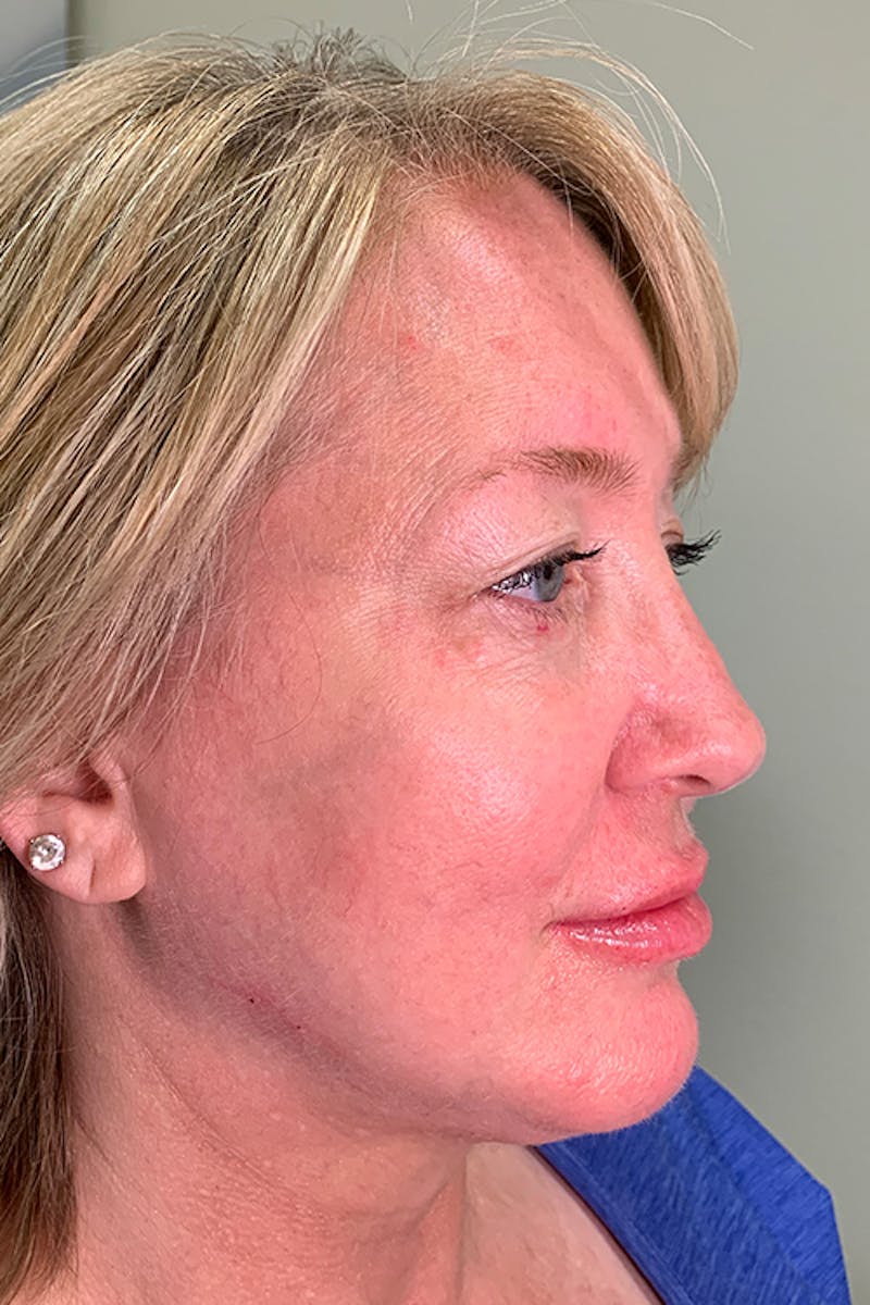 Facial Fillers Before & After Gallery - Patient 51538720 - Image 4