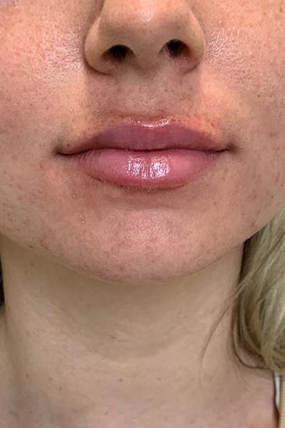 Lip Fillers Before & After Gallery - Patient 51538722 - Image 2