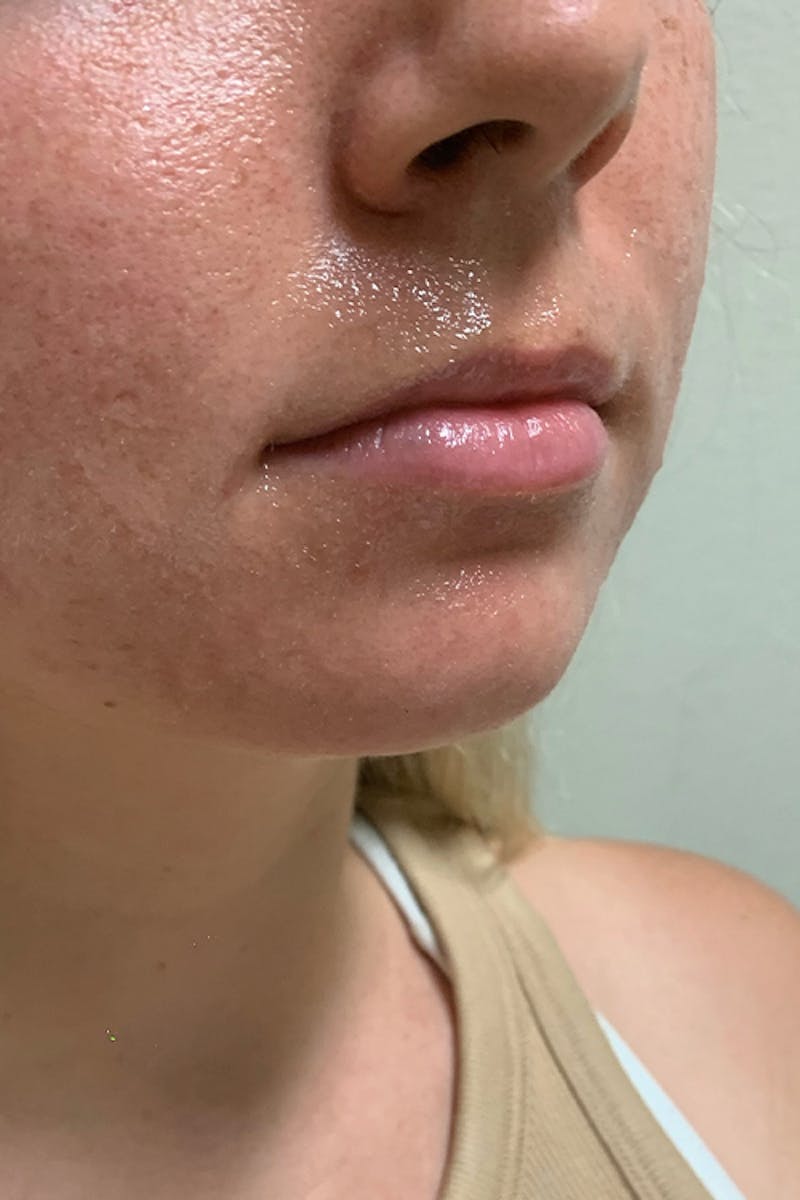 Lip Fillers Before & After Gallery - Patient 51538722 - Image 3