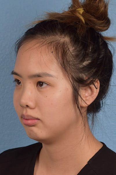 Facial Fillers Before & After Gallery - Patient 51538724 - Image 1