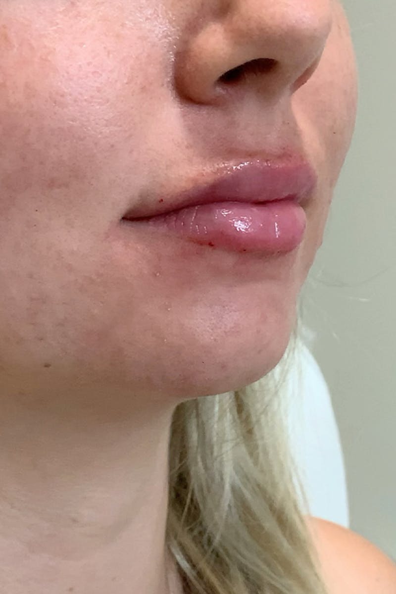 Lip Fillers Before & After Gallery - Patient 51538722 - Image 4