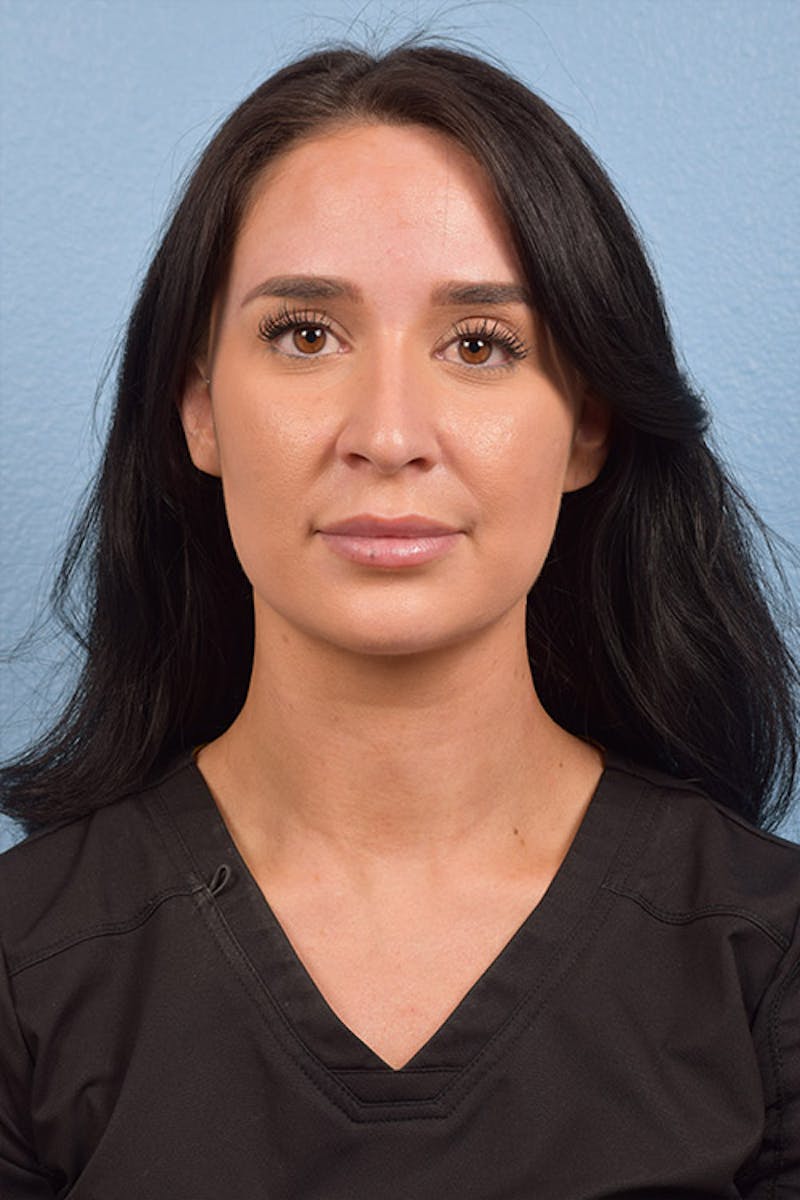 Injectables Before & After Gallery - Patient 51538723 - Image 1