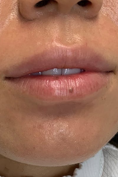 Lip Fillers Before & After Gallery - Patient 51538727 - Image 1