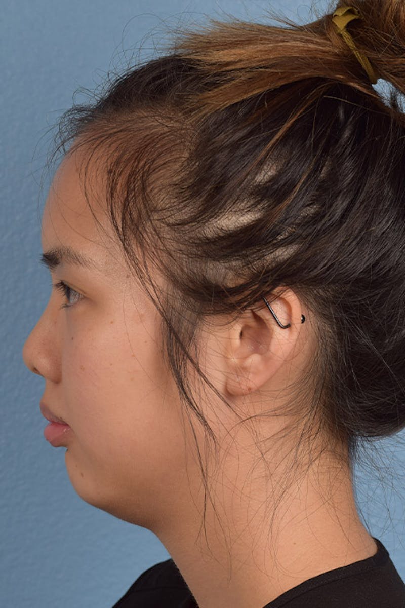 Facial Fillers Before & After Gallery - Patient 51538724 - Image 3