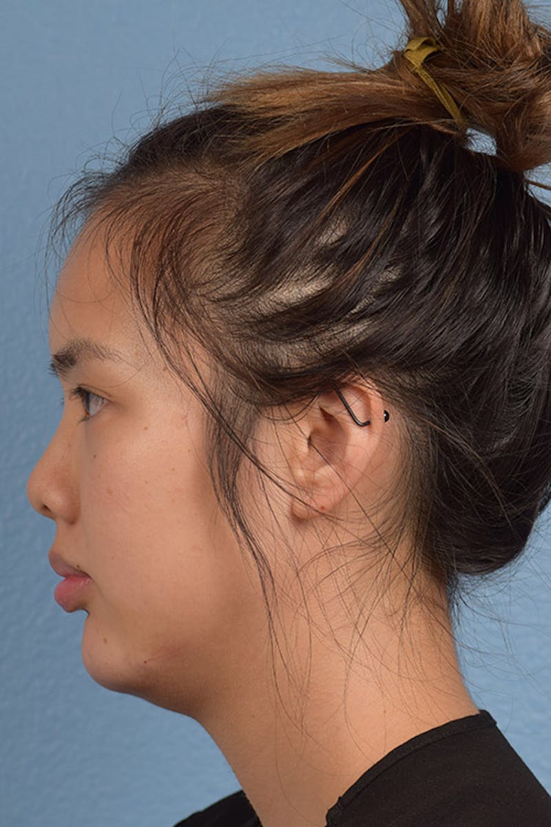 Facial Fillers Before & After Gallery - Patient 51538724 - Image 4