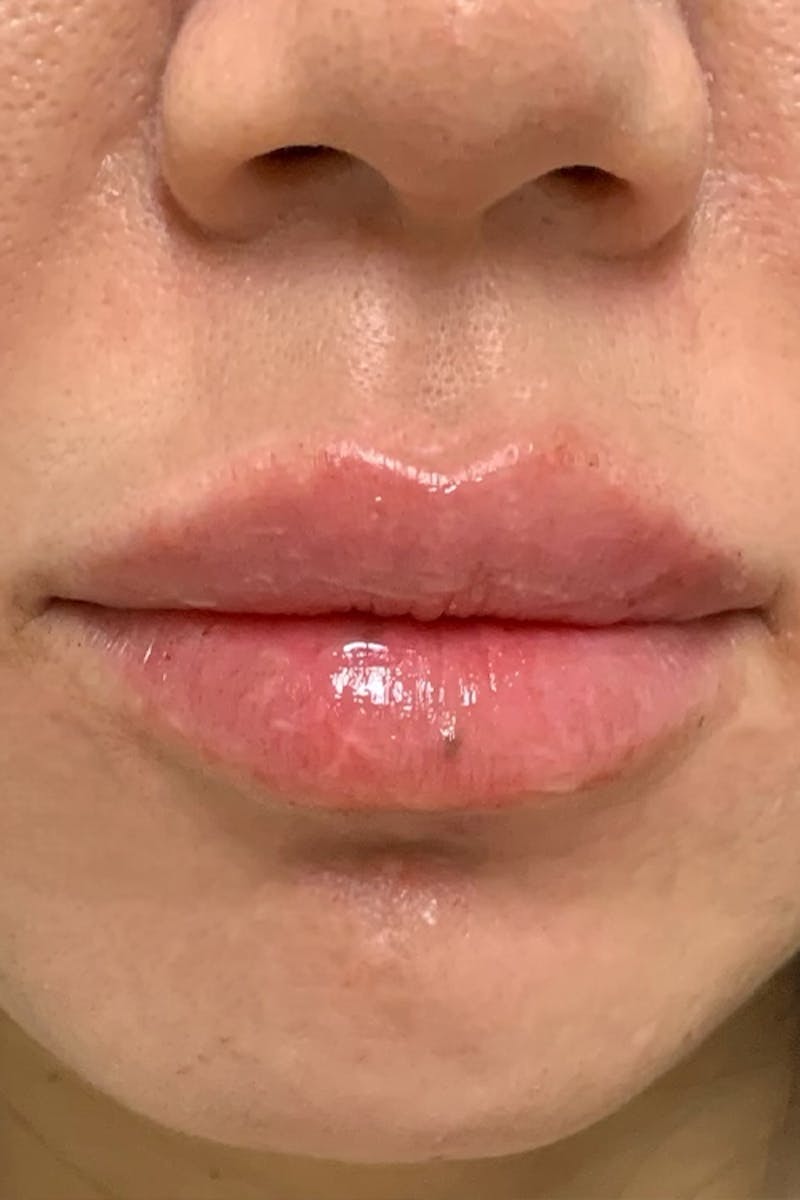 Lip Fillers Before & After Gallery - Patient 51538727 - Image 2