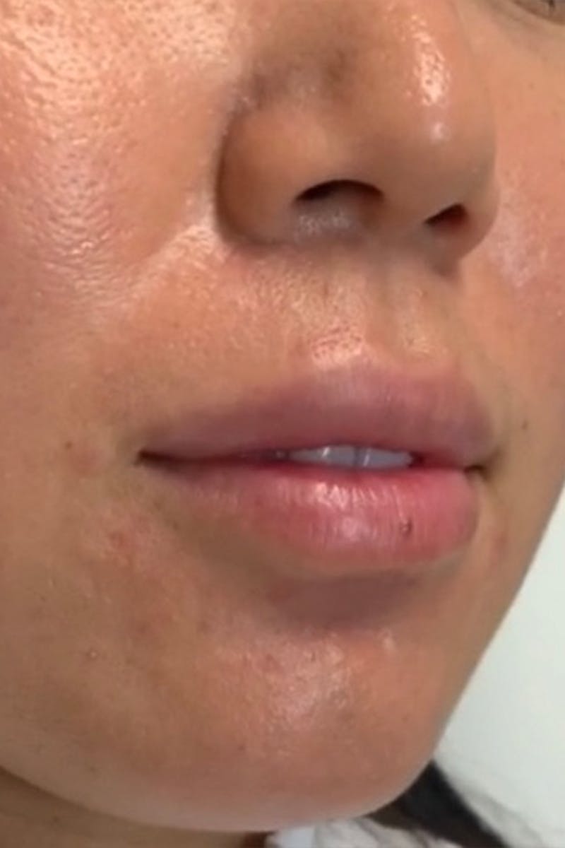 Lip Fillers Before & After Gallery - Patient 51538727 - Image 3